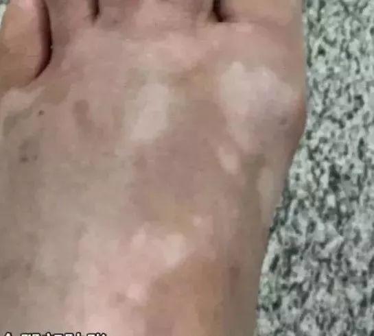可怕！东莞一小区惊现多种毒蛇，多人被咬中毒！