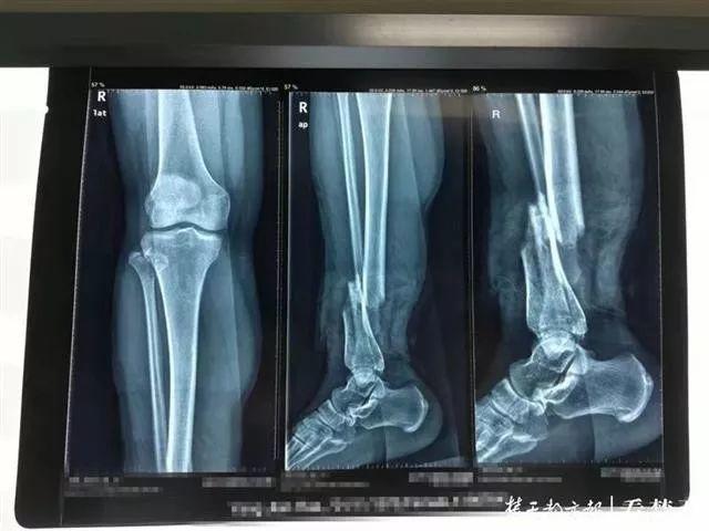 又出事了！女子在这种“网红桥”上被甩出，结果…