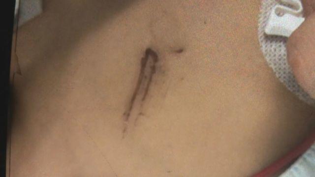 丧心病狂！1岁多女童被钢管戳胸、烟头烫肤，被摔死！