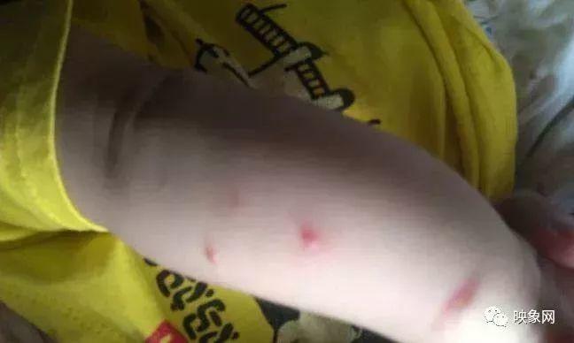 突发！2个孩子被感染！东莞这个传染病进入高发期！严重会致死！