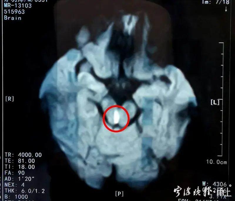 早起连喝两瓶“快乐肥宅水”，小伙突然视线模糊，一查竟患了这种老年病！眼球也坏了