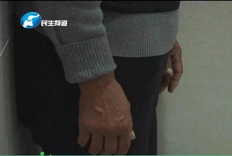 痛心！13个月大宝宝被咬掉半边脸！狗主人:“我的狗没咬过人”