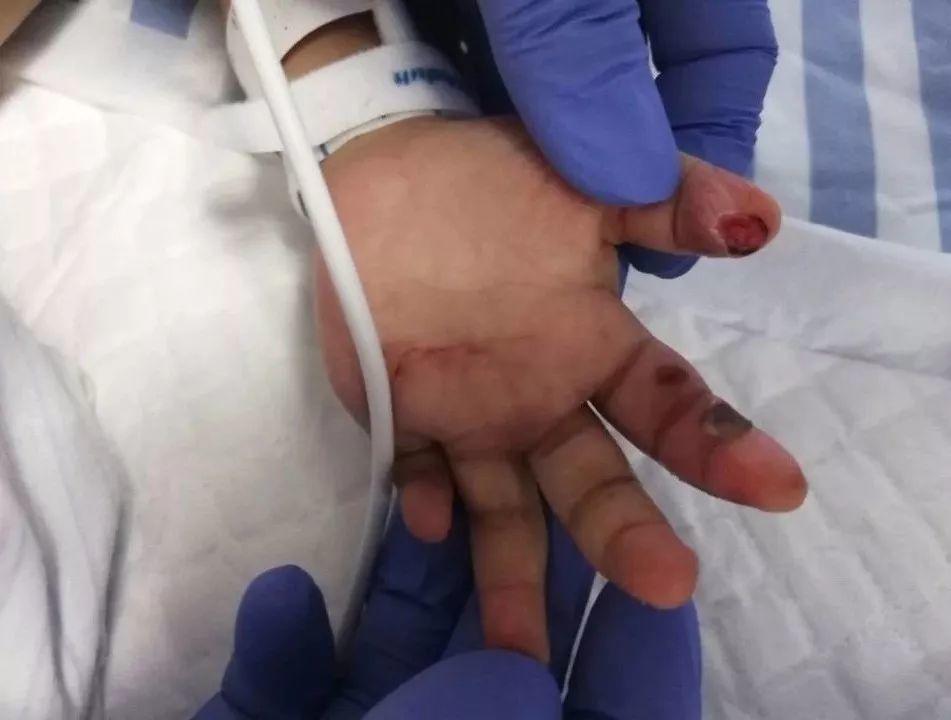 丧心病狂！1岁多女童被钢管戳胸、烟头烫肤，被摔死！