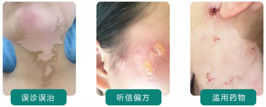 重要通知！白癜风新诊疗政策出台，限额50人招募援助申领
