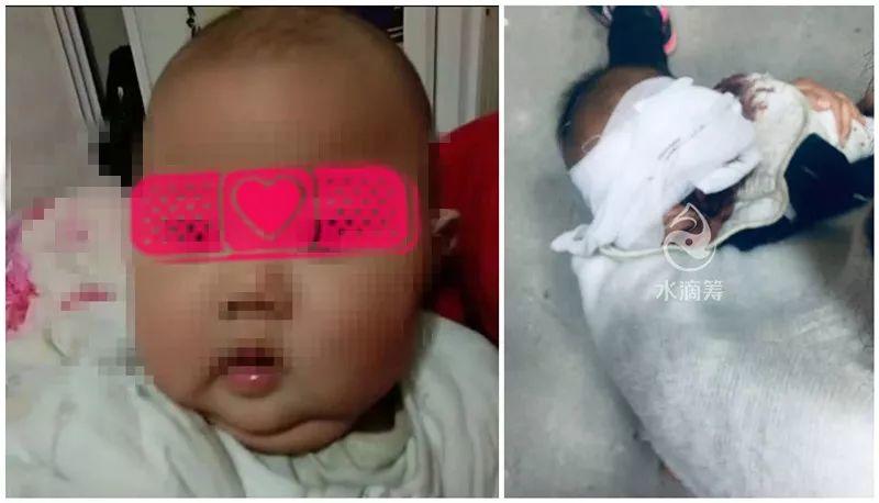 痛心！13个月大宝宝被咬掉半边脸！狗主人:“我的狗没咬过人”
