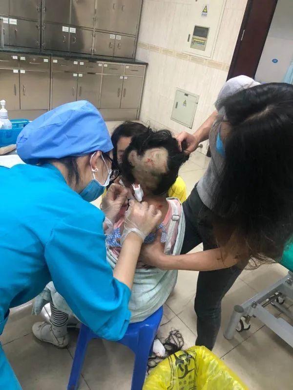 吓人！东莞小女孩遭邻居宠物狗疯狂扑咬，头部被咬伤！