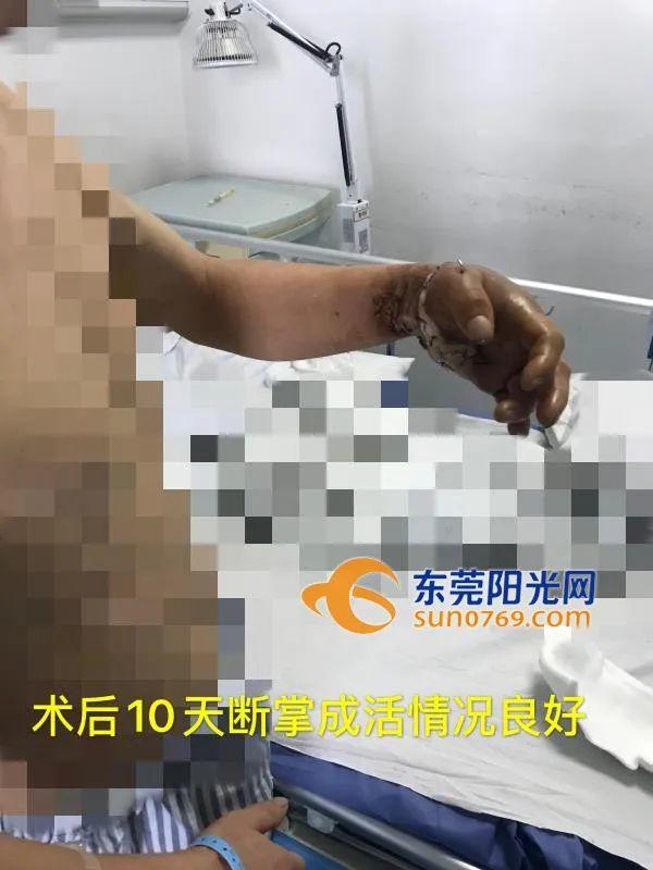 痛！东莞一饭堂厨师砍猪脚时竟砍断自己的手！医生们彻夜奋斗…