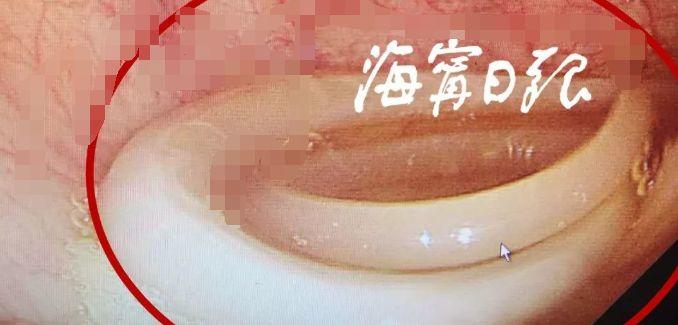 女子肚子痛了10多年，一查医生都吓一跳！腹中竟取出30厘米长的...