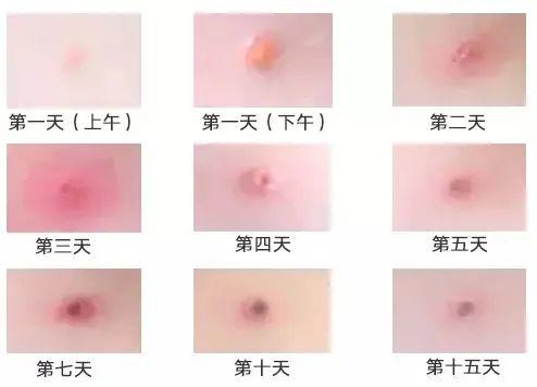 紧急提醒！这种传染病进入高发期！有学校已停课！