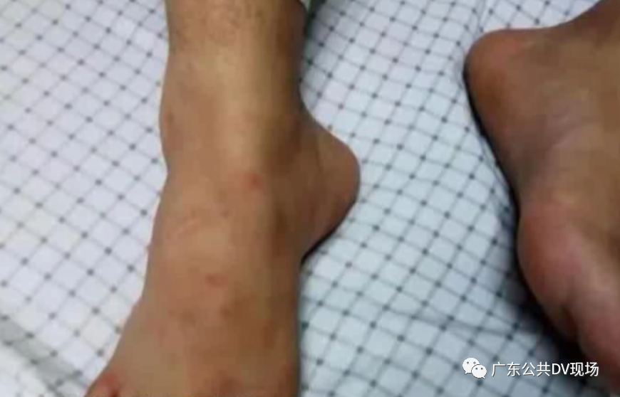 东莞夏天常见的这种小动物，多人被咬伤送院！这个情况一定要谨慎！