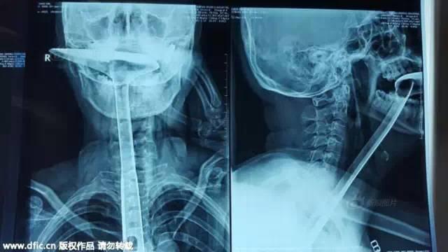 奇葩！东莞男子将18cm长的瓶子捅进肛门！竟是为了解决…