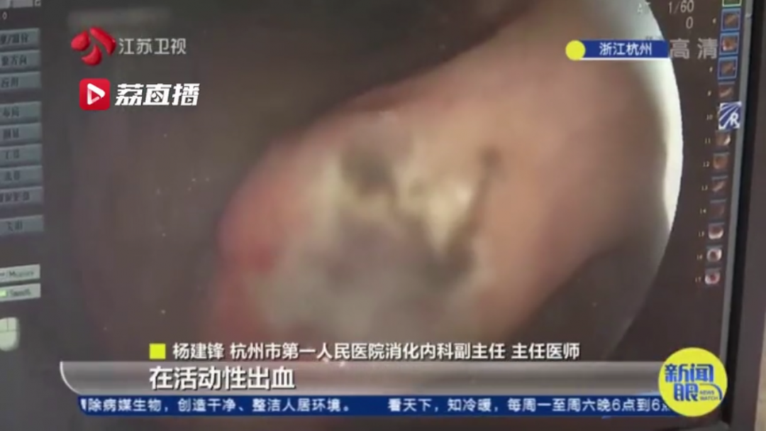 阿伯连食3天这种蔬菜，搞到胃出血！医生：不是人人能吃的...