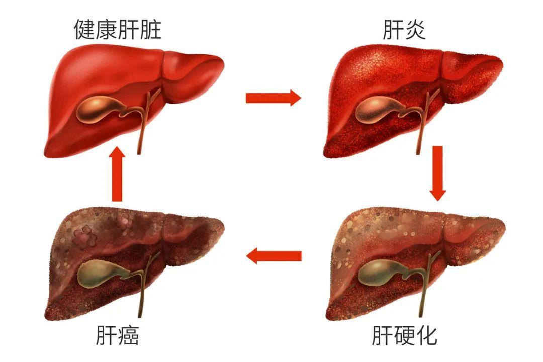 吴孟达走了，肝癌为何发现即晚期？这5类人要特别注意！