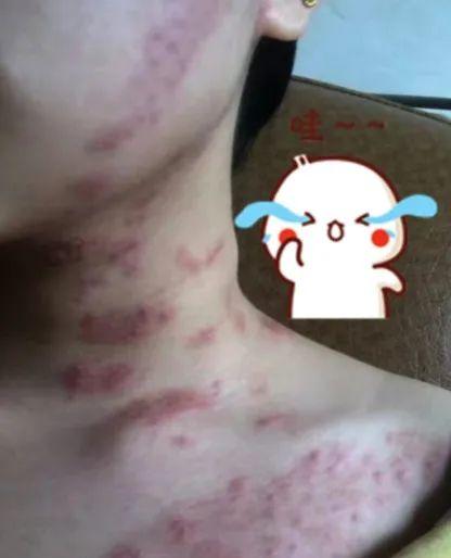 春季多发！23岁女子一夜之间脸脖冒出这些东西！医生紧急提醒→