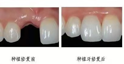 重磅福利！德国植体厂家直销千人团购会空降东莞，轻松实现种牙自由！