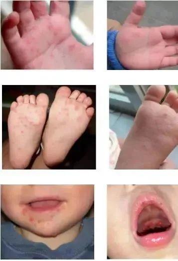 近期高发！广东疾控紧急提醒！这些预防是关键