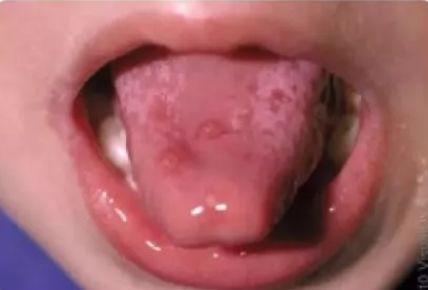 紧急提醒！传染性极强！这个病东莞进入高发期！