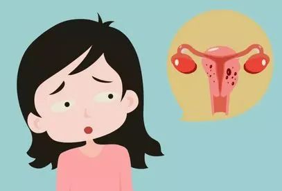 月经异常、不孕？注意了！你可能被这种“瘤”找上门了！