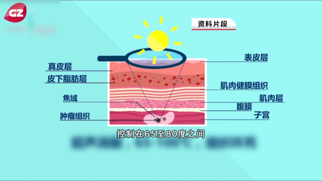 月经异常、不孕？注意了！你可能被这种“瘤”找上门了！