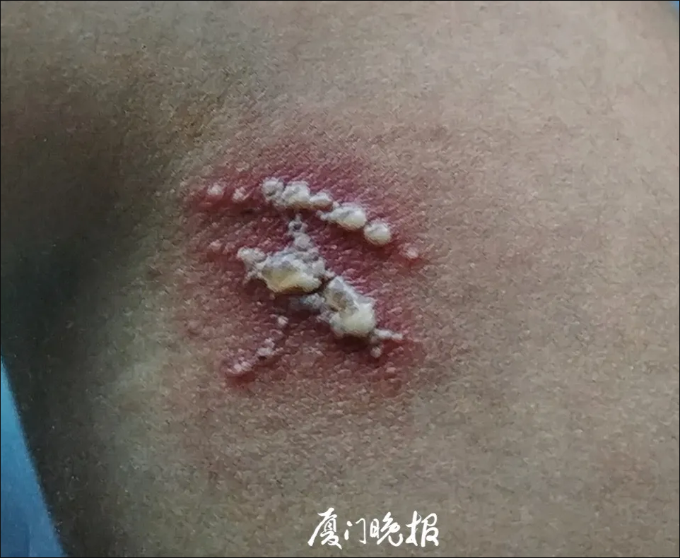 又是它！女子半夜关灯玩手机，差点致毁容！