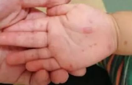 突发！又一致死病毒进入高发期！东莞疾控发布紧急提醒！