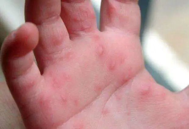 突发！又一致死病毒进入高发期！东莞疾控发布紧急提醒！