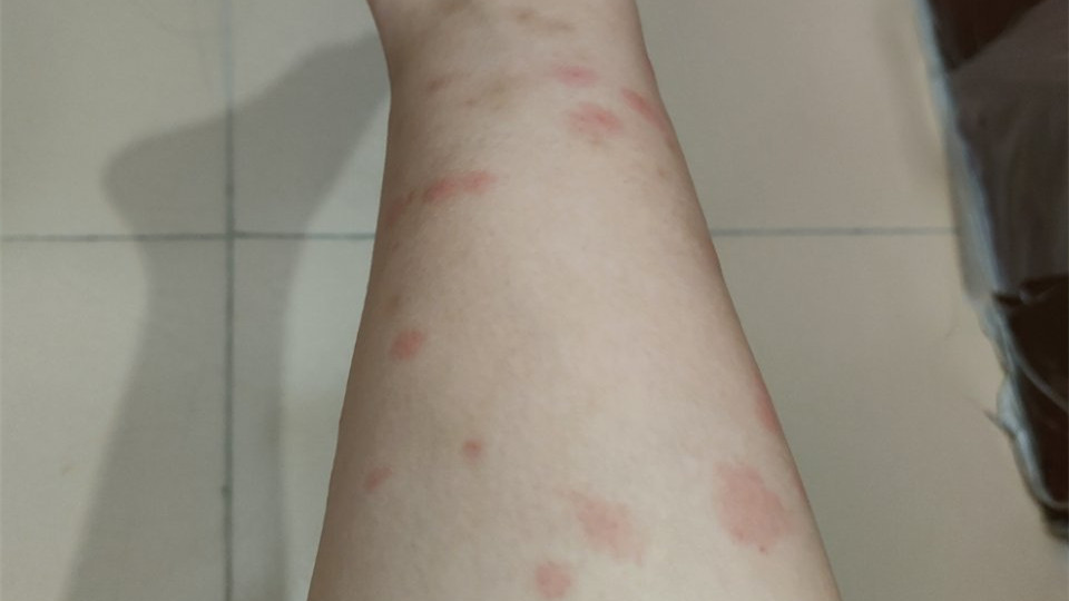 紧急提醒！东莞这种虫子比蚊子还毒，咬个包要痒几天几夜！