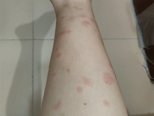 紧急提醒！东莞这种虫子比蚊子还毒，咬个包要痒几天几夜！