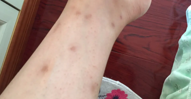 紧急提醒！东莞这种虫子比蚊子还毒，咬个包要痒几天几夜！