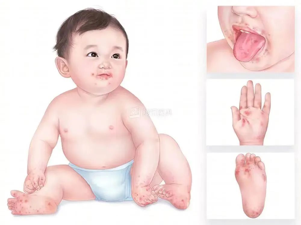 警惕！传染性极强！东莞疾控​紧急提醒！！！