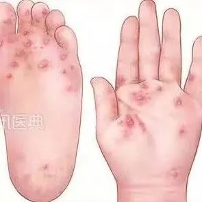 警惕！传染性极强！东莞疾控​紧急提醒！！！