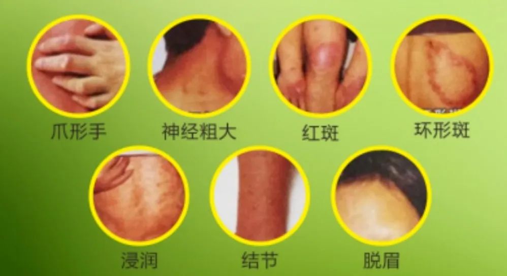 东莞人警惕！广东一地发现2例！出现这些症状要当心→