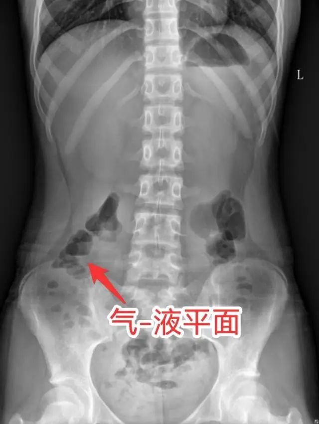 连吐10余次，12岁男孩紧急送医！春节这个坏习惯很多人都有→